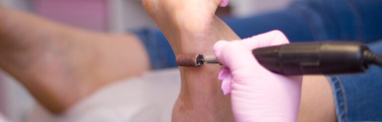 Schützende Hornhaut oder behandlungsbedürftige Schwiele? Risiken, sichere Entfernung und Prävention bei Podologie Berlin
