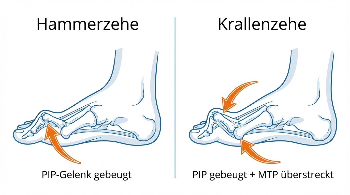 Infografik: Unterschied zwischen Hammerzehe und Krallenzehe – PIP-Gelenk und MTP-Gelenk Fehlstellung im Vergleich