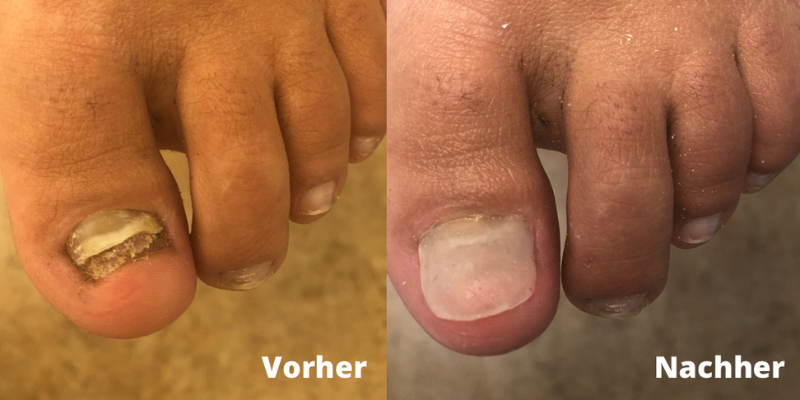 Podologie Berlin Vorher Nachher