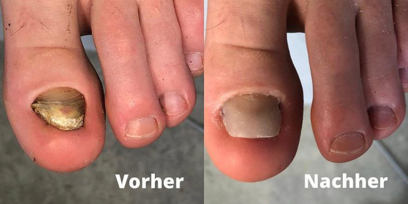Podologie Berlin Vorher Nachher