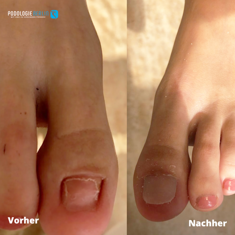 Podologie Berlin Vorher Nachher