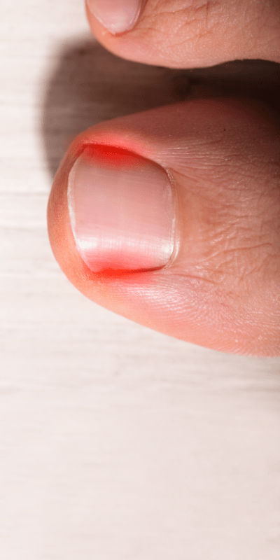 Ein Foto eines Fußes mit einem eingewachsenen Zehennagel. Der Nagel sieht rot und entzündet aus